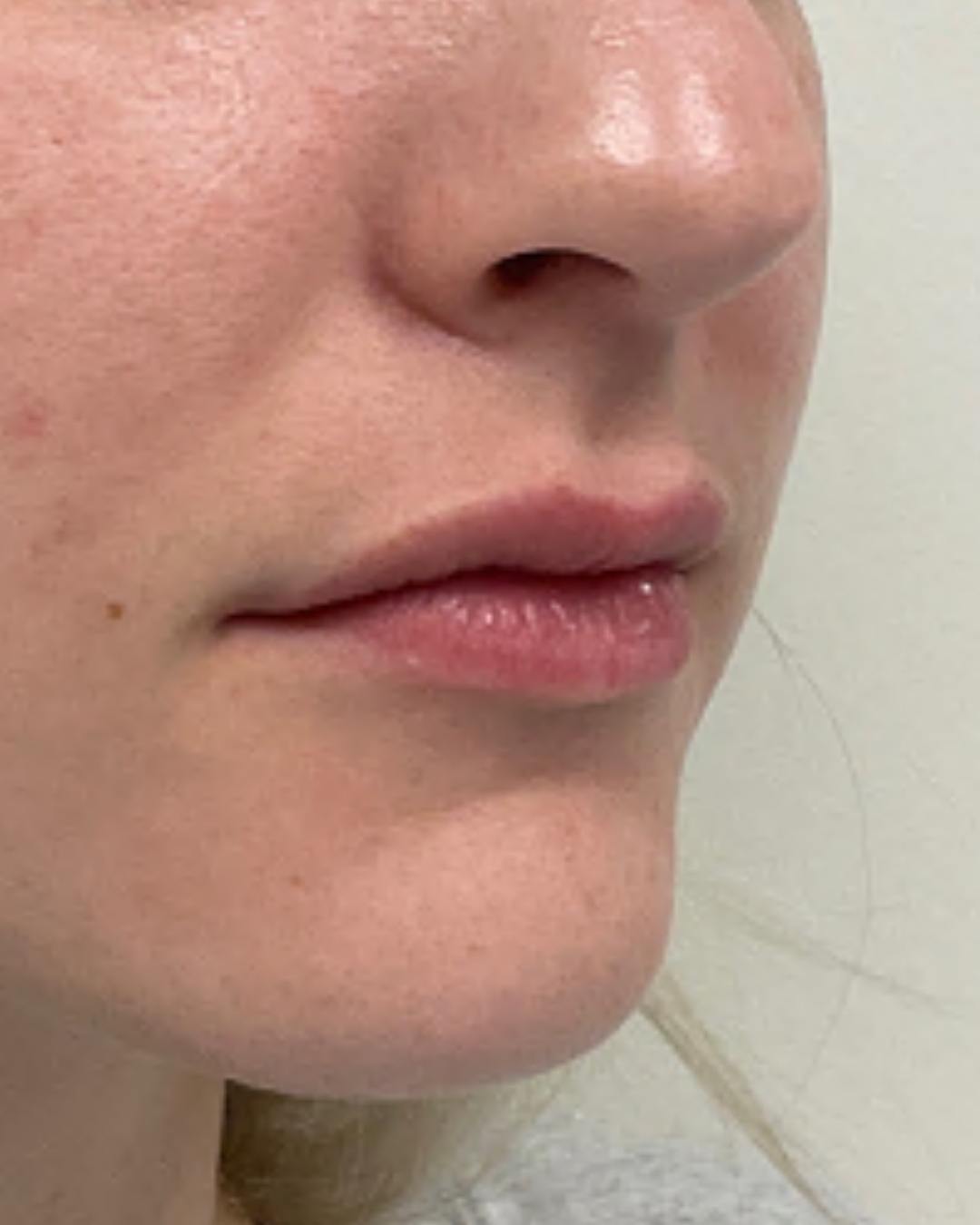 case 60 before lip filler