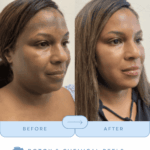 botox and chemcial peel series at cool springs plastic surgery in brentwood