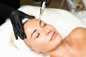 Woman relaxes and undergoes a microneedling treatment to improve the texture of her skin.