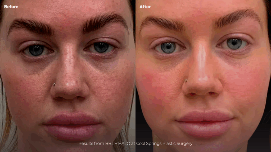 Before and after of female patient treated with BBL and HALO laser at Cool Springs Plastic Surgery in Nashville for sun damage and skin texture improvement.