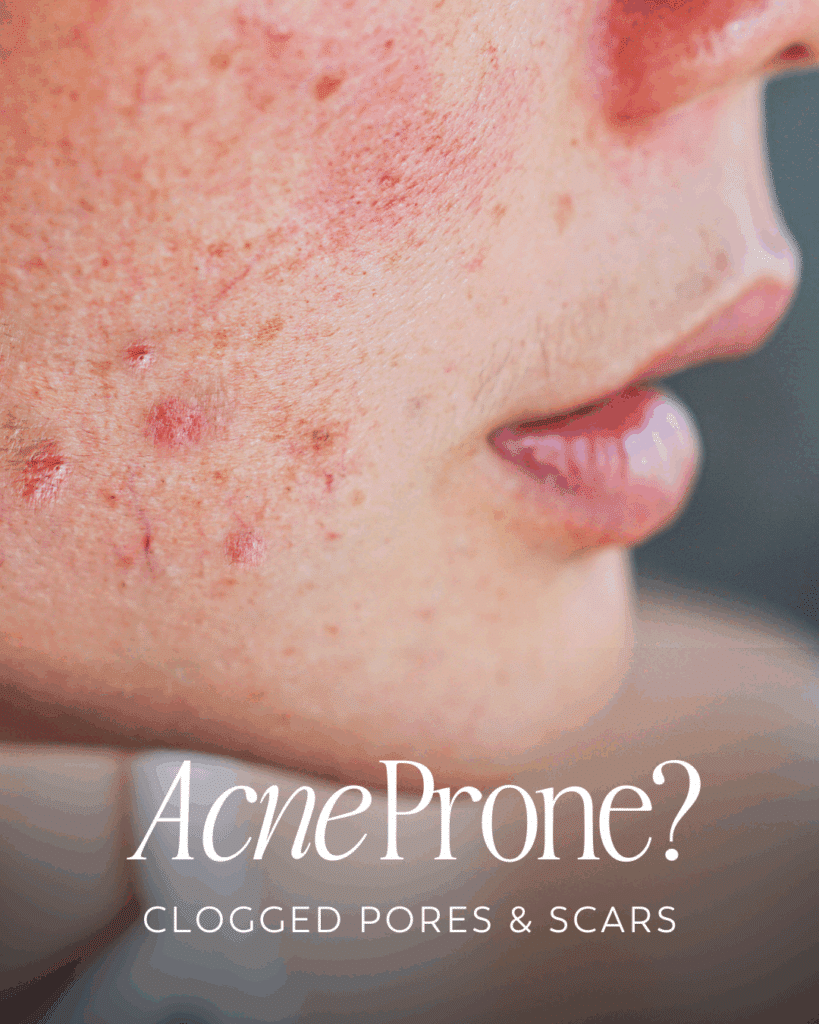 Treat sun damage, brown spots, and freckles with BBL™, HALO™, or MOXI™ laser treatments in Nashville. Expert care for brighter, even-toned skin at Cool Springs Plastic Surgery.