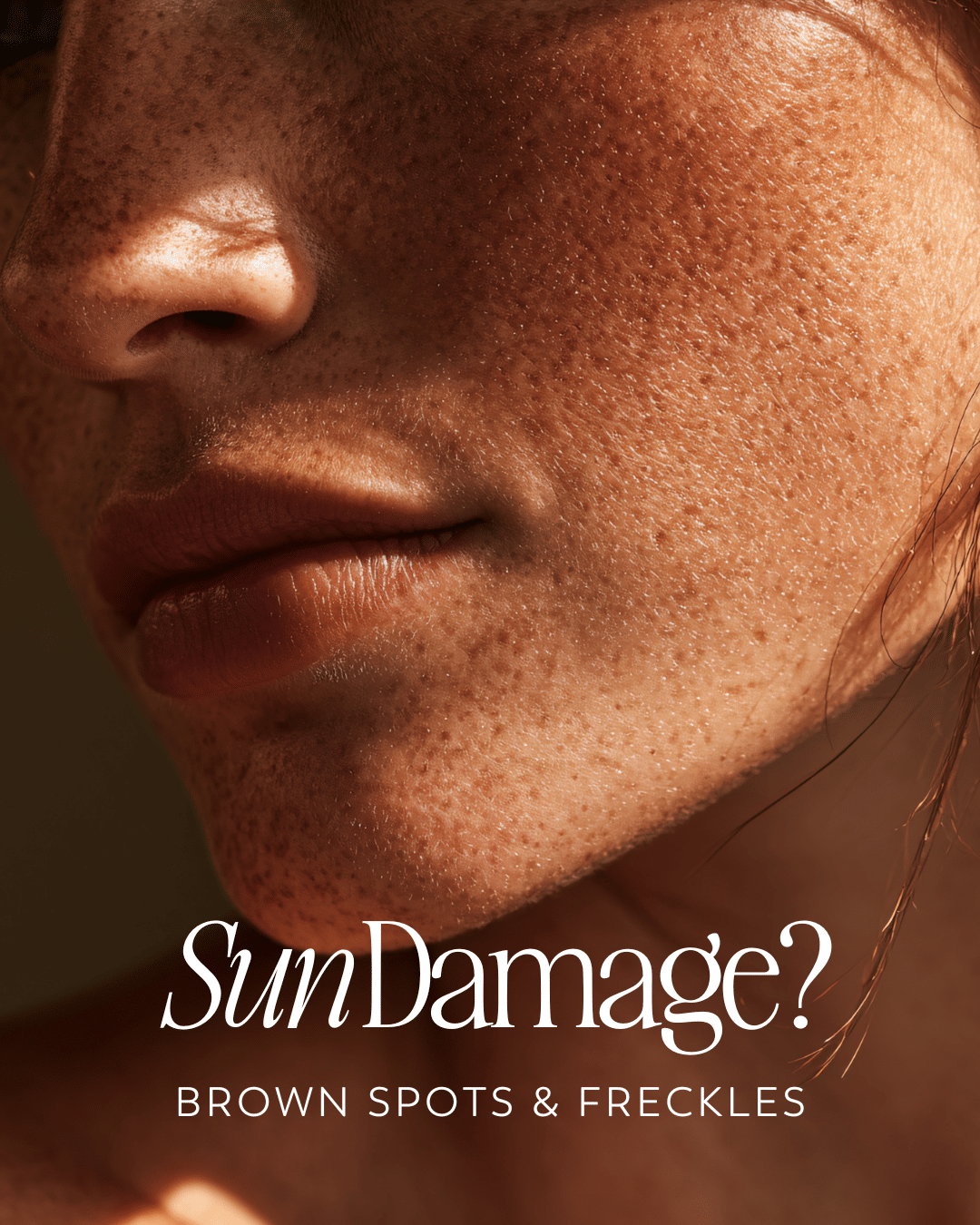 Woman with visible freckles and sun damage – treated with BBL laser in Nashville to correct brown spots and improve skin tone.