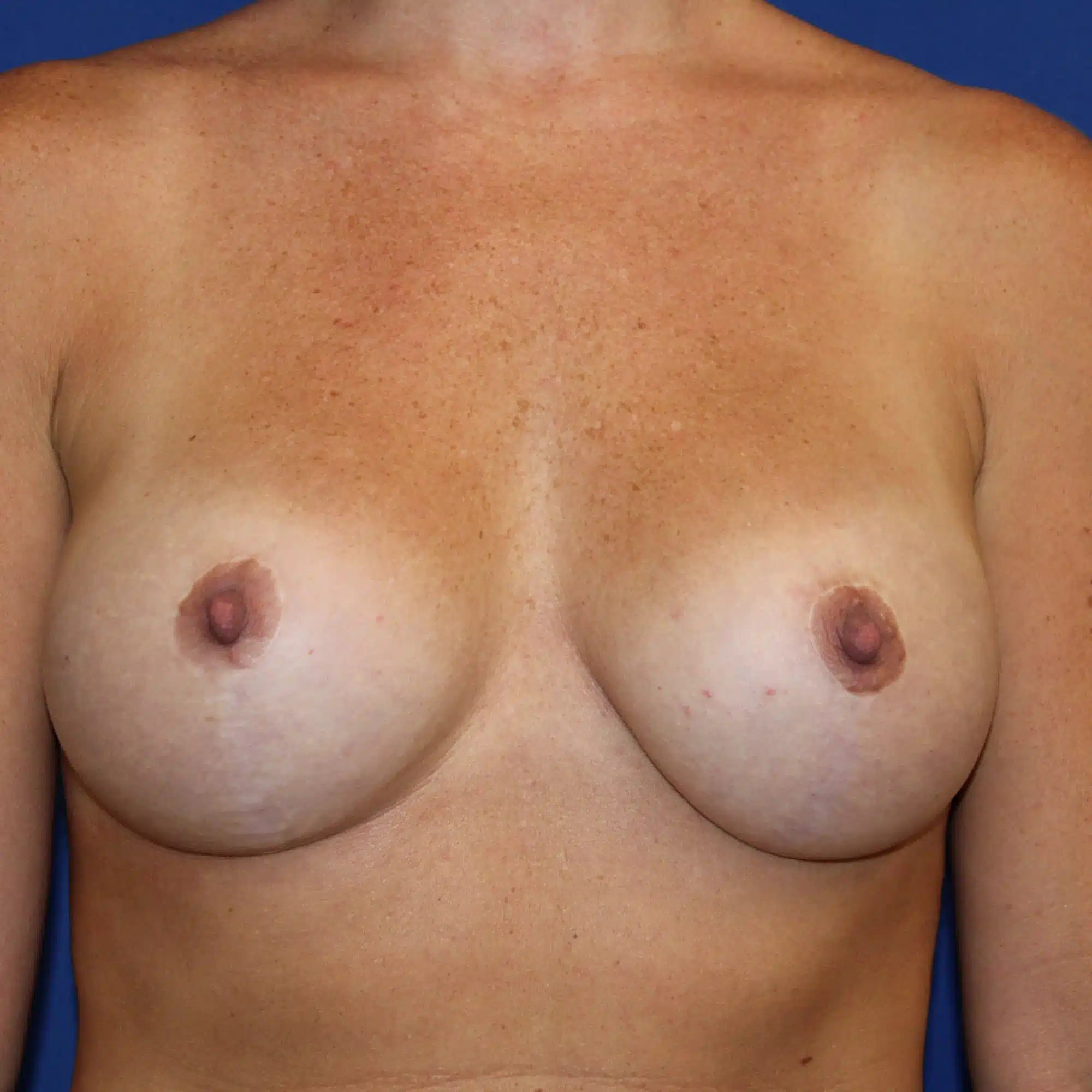 Breast augmentation mastopexy before and after by Dr. Konrad Sarosiek – 310cc silicone implant, dual-plane placement (case 1043)