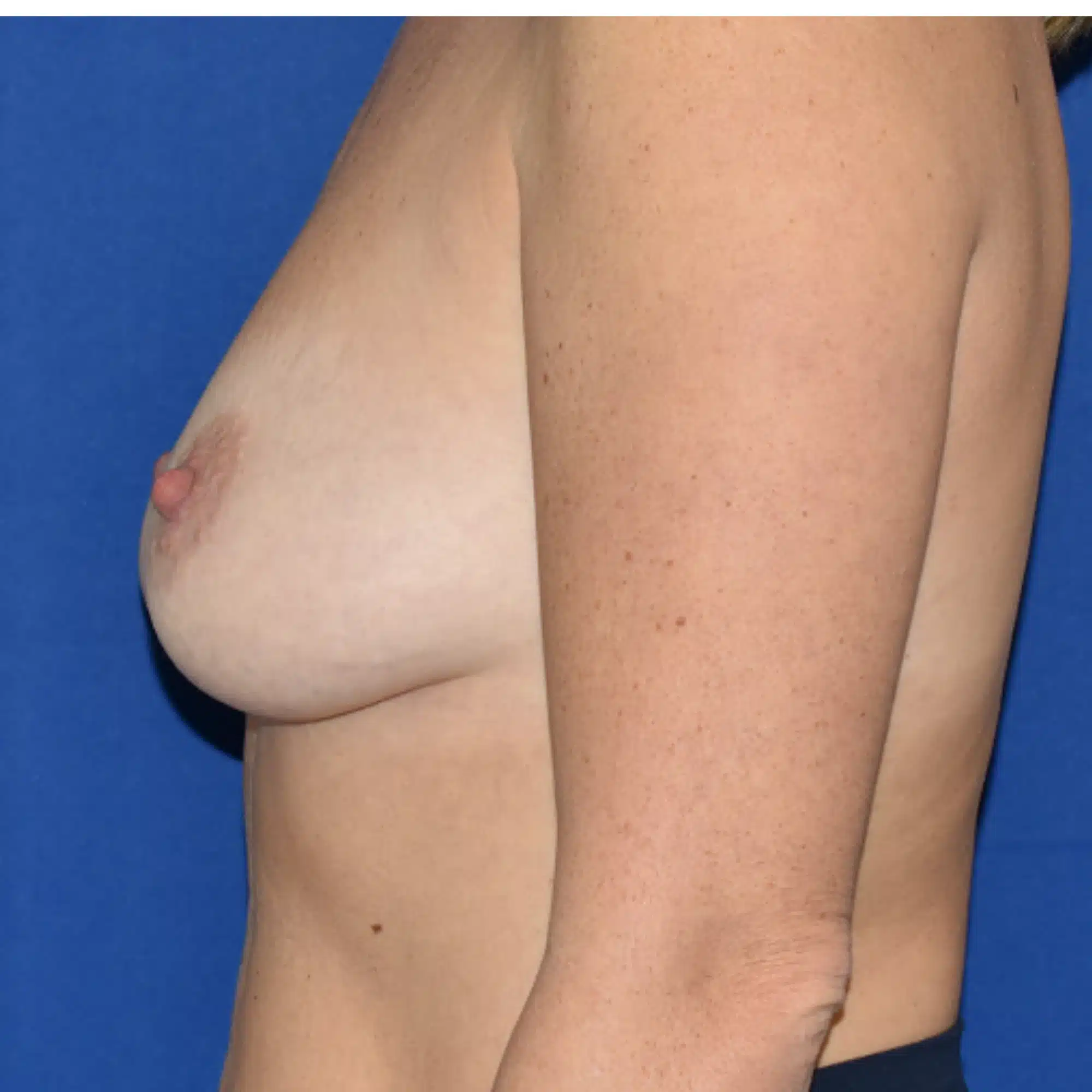 Breast augmentation mastopexy before and after by Dr. Konrad Sarosiek – 310cc silicone implant, dual-plane placement (case 1043)