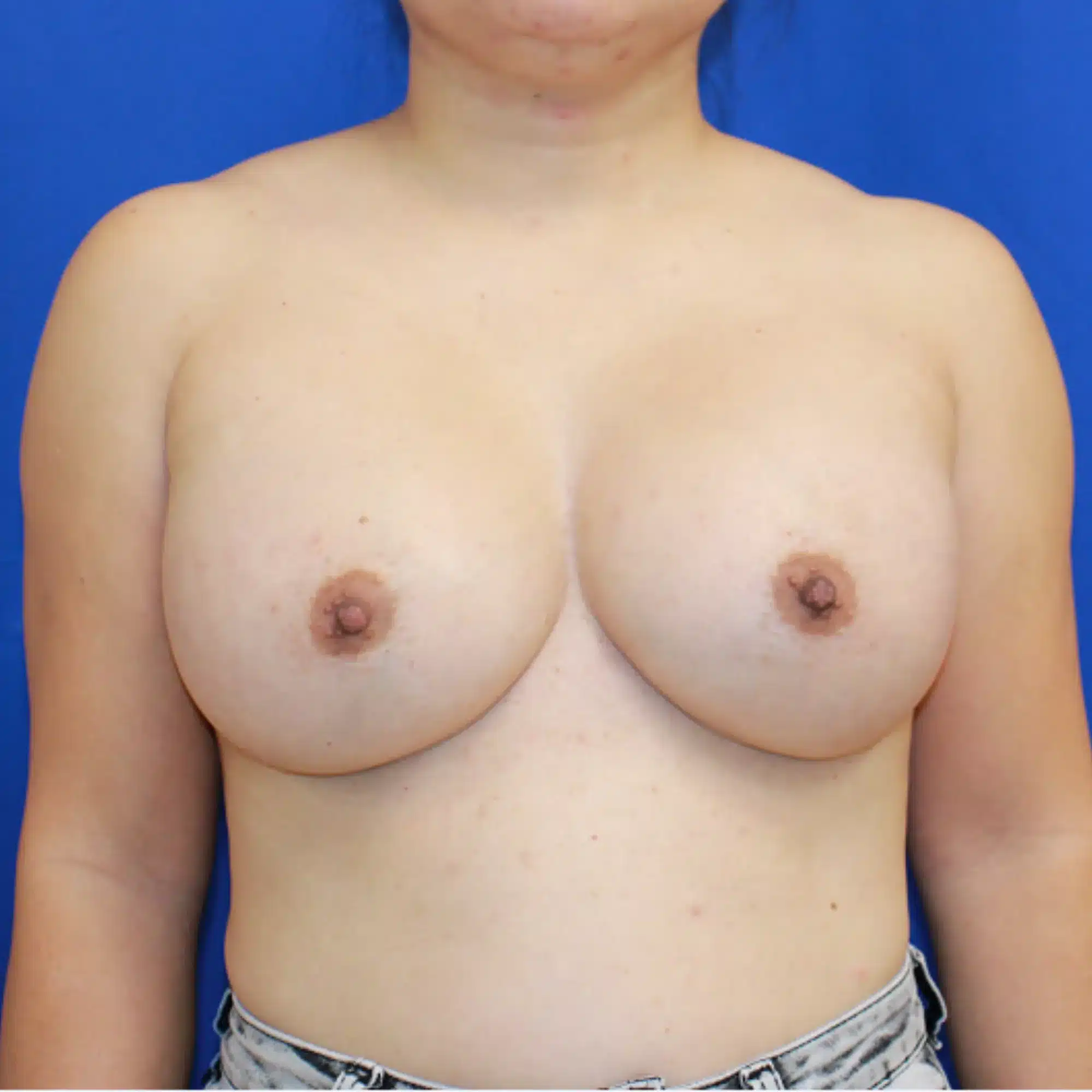 Breast augmentation before and after photos by Dr. Konrad Sarosiek – Case 1044