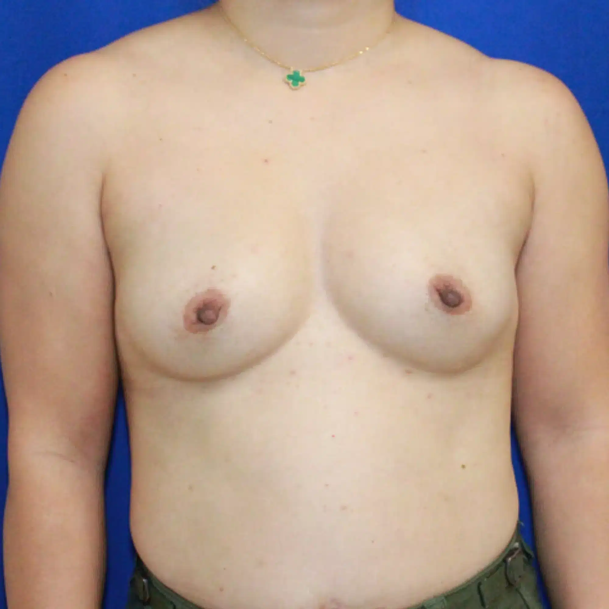 Breast augmentation before and after photos by Dr. Konrad Sarosiek – Case 1044