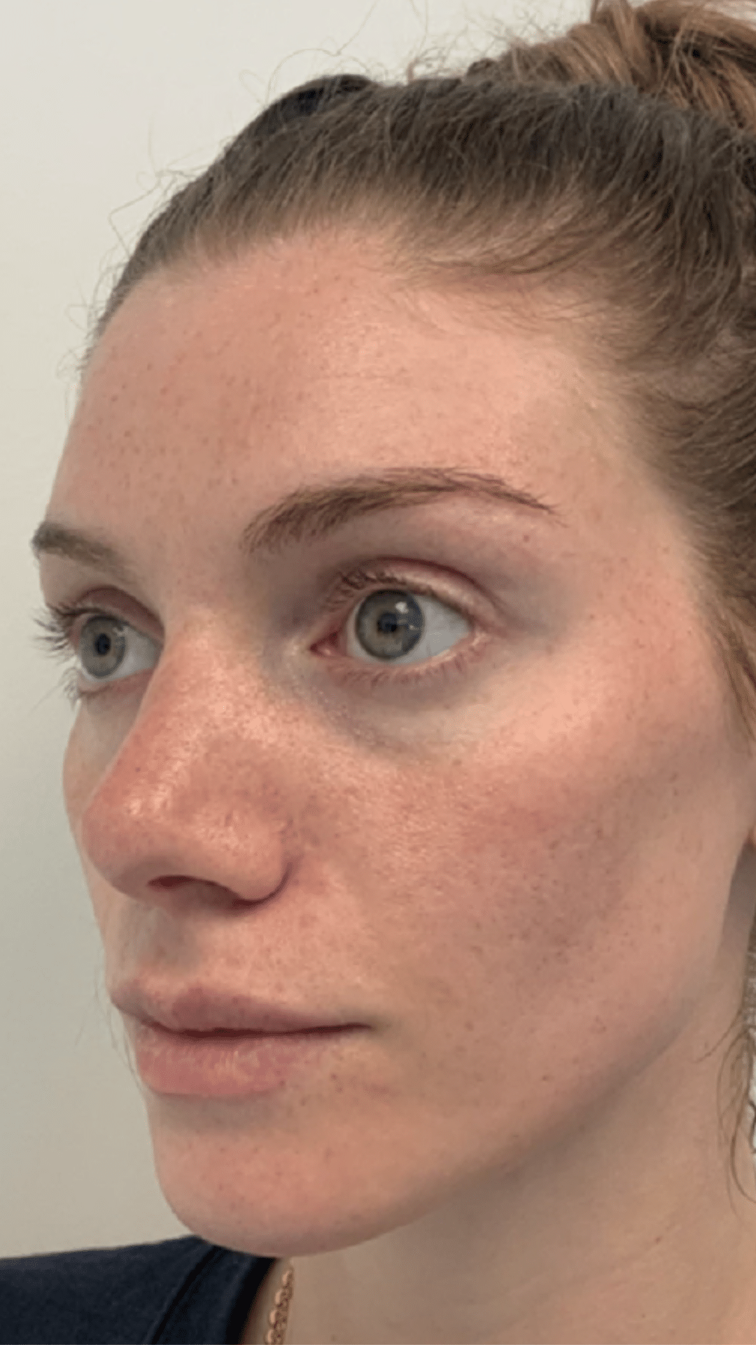 Cheek filler by Chrissy Handly at Cool Springs Plastic Surgery in Brentwood and Franklin, TN showing natural midface rejuvenation and balanced results.