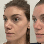 See cheek filler before-and-after results by Chrissy Handly, RN at Cool Springs Plastic Surgery in Nashville.
