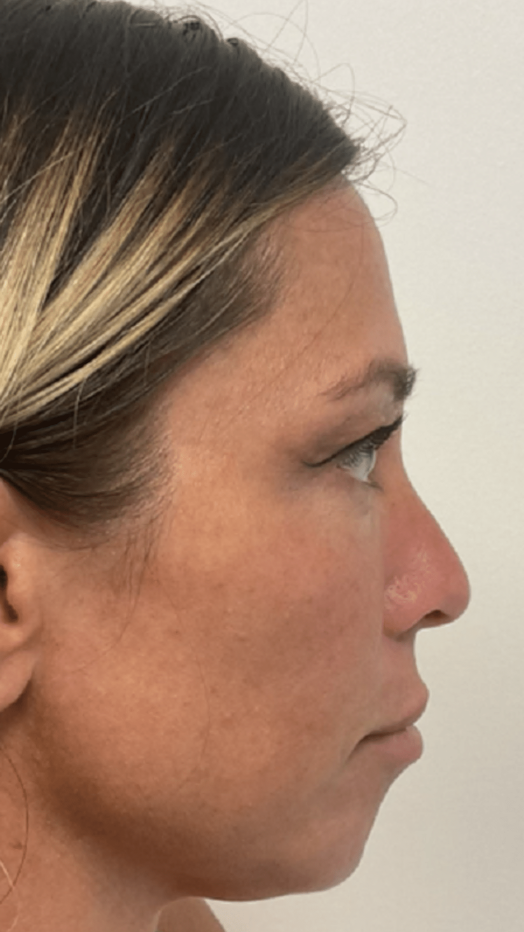 acial balancing filler by Chrissy Handly, RN at Cool Springs Plastic Surgery in Brentwood and Franklin