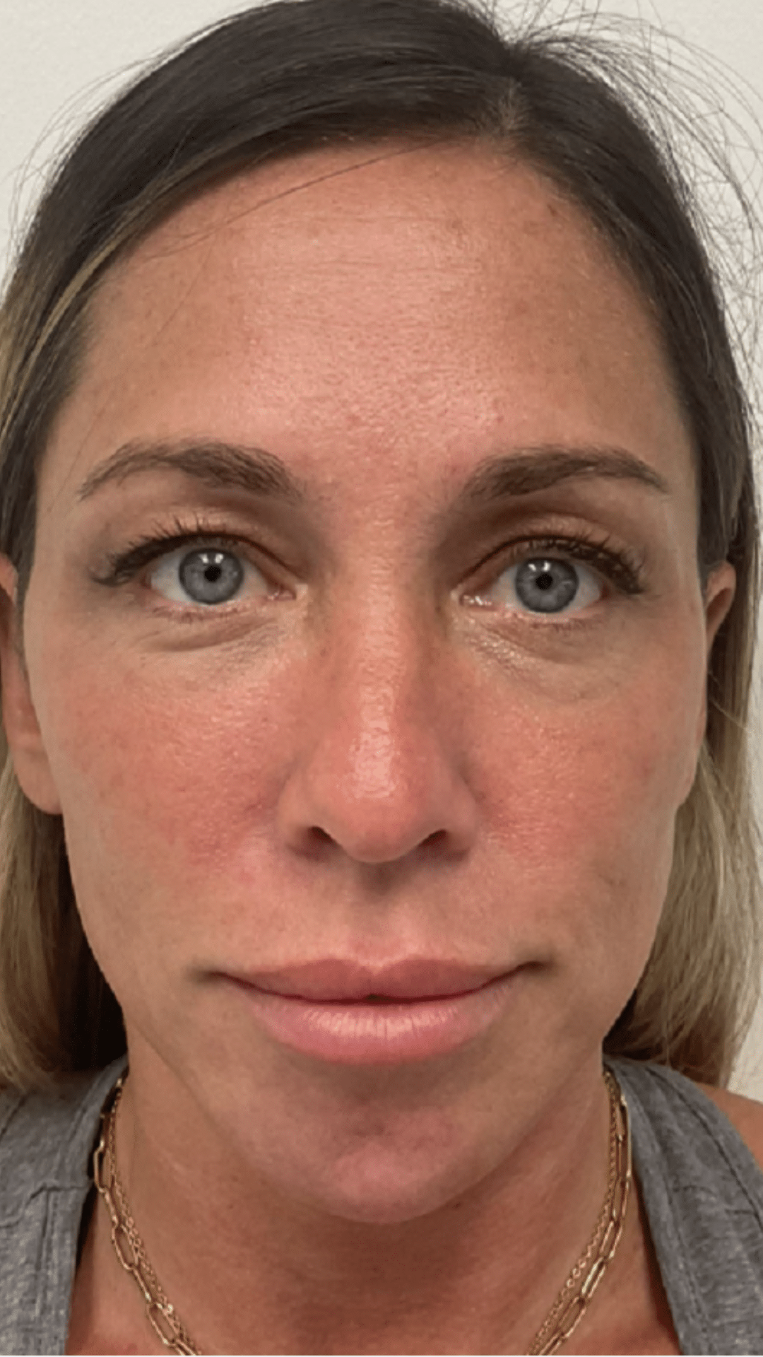 acial balancing filler by Chrissy Handly, RN at Cool Springs Plastic Surgery in Brentwood and Franklin