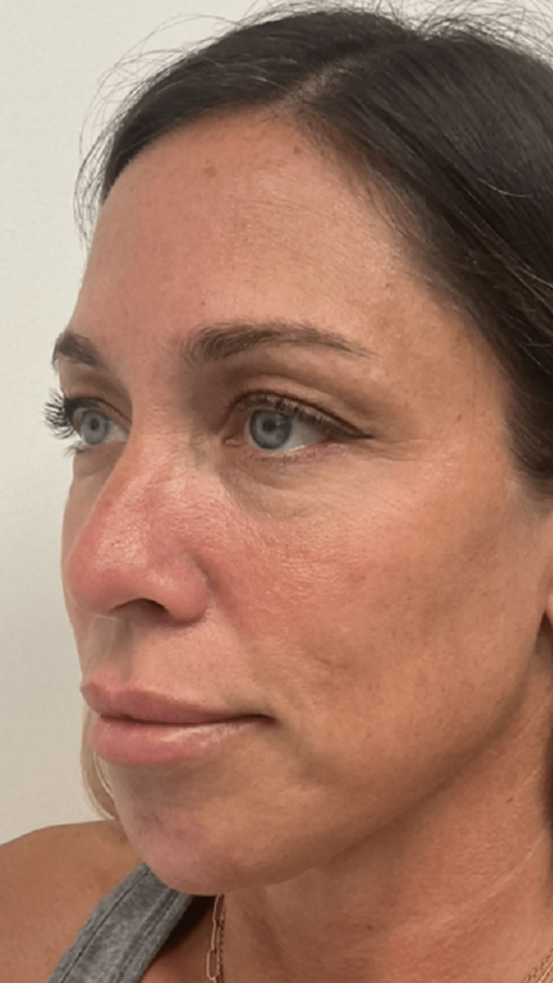acial balancing filler by Chrissy Handly, RN at Cool Springs Plastic Surgery in Brentwood and Franklin
