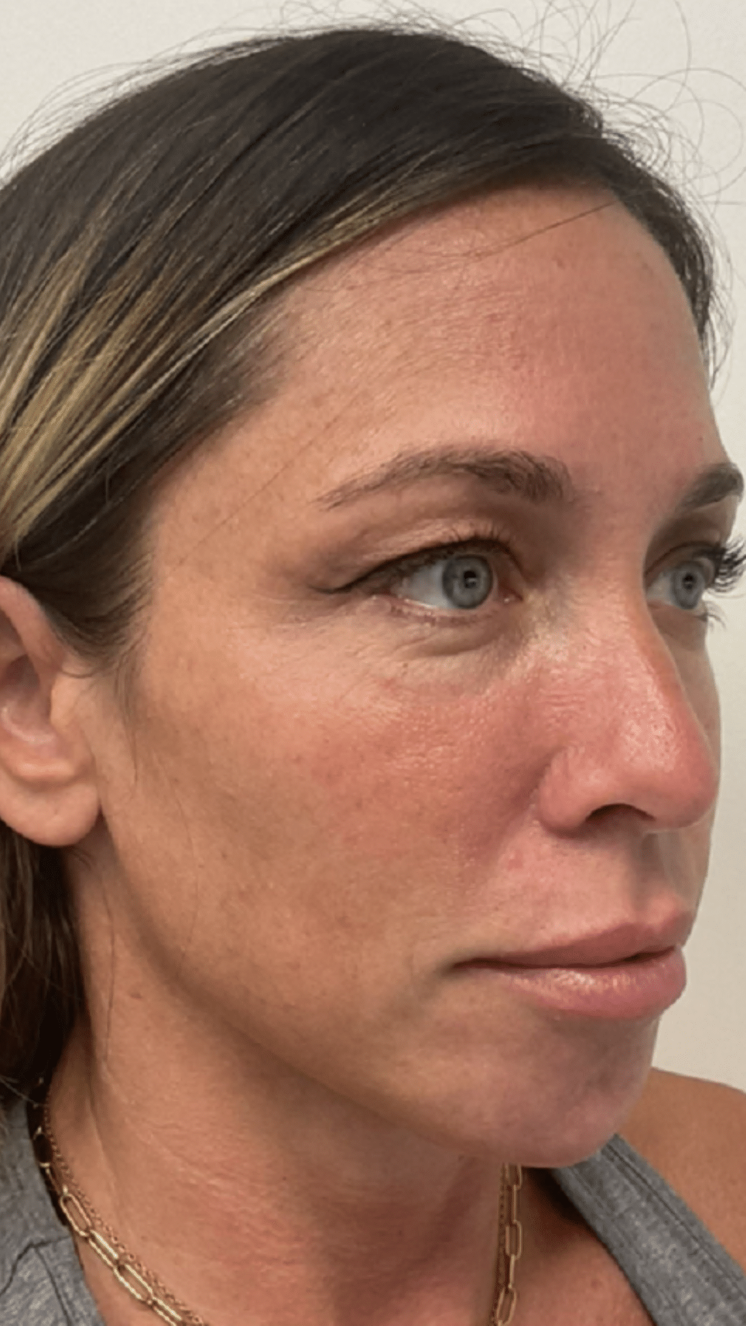 acial balancing filler by Chrissy Handly, RN at Cool Springs Plastic Surgery in Brentwood and Franklin