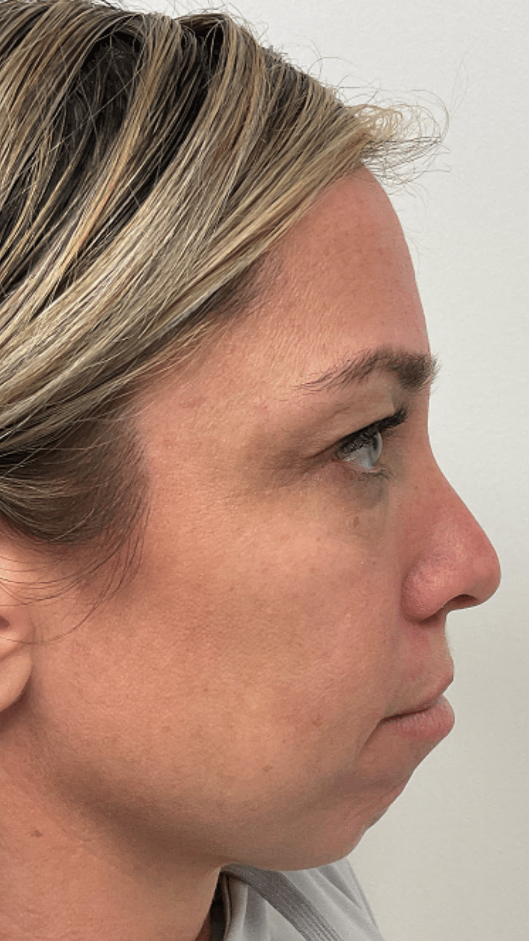 acial balancing filler by Chrissy Handly, RN at Cool Springs Plastic Surgery in Brentwood and Franklin