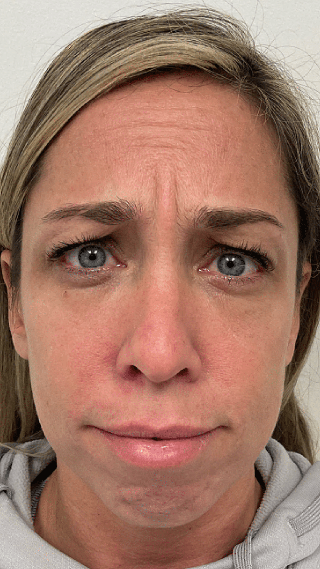 acial balancing filler by Chrissy Handly, RN at Cool Springs Plastic Surgery in Brentwood and Franklin