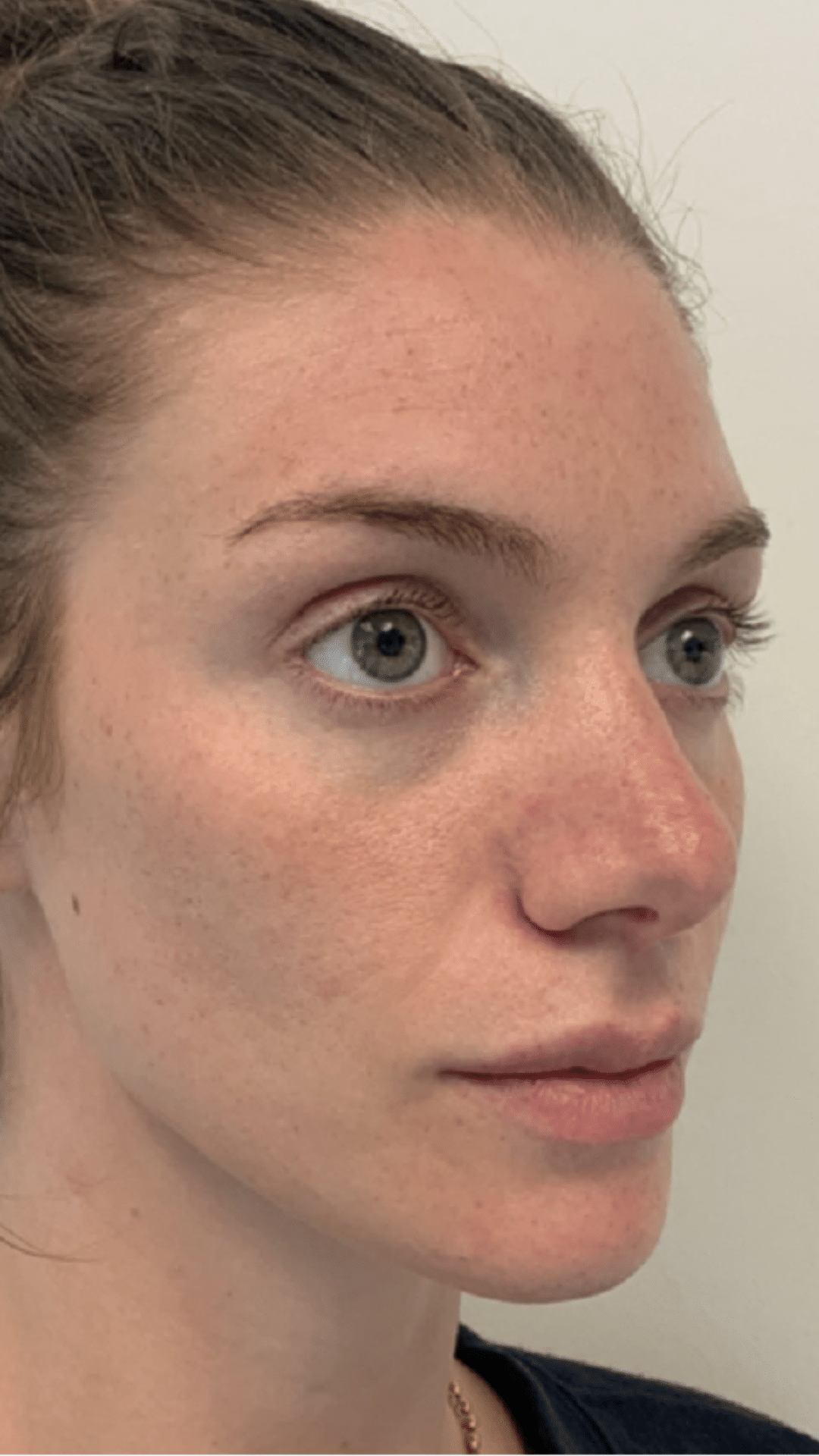 Cheek filler by Chrissy Handly at Cool Springs Plastic Surgery in Brentwood and Franklin, TN
