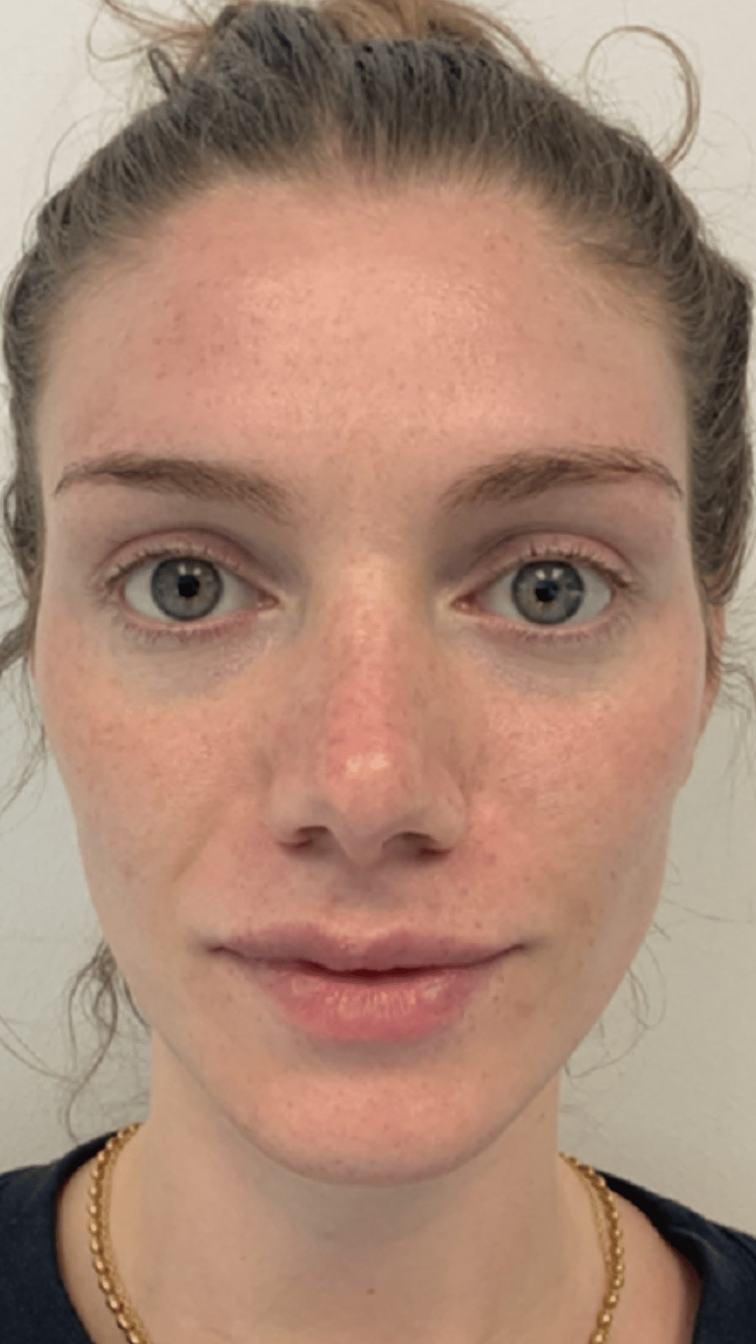 Cheek filler by Chrissy Handly at Cool Springs Plastic Surgery in Brentwood and Franklin, TN showing natural midface rejuvenation and balanced results.