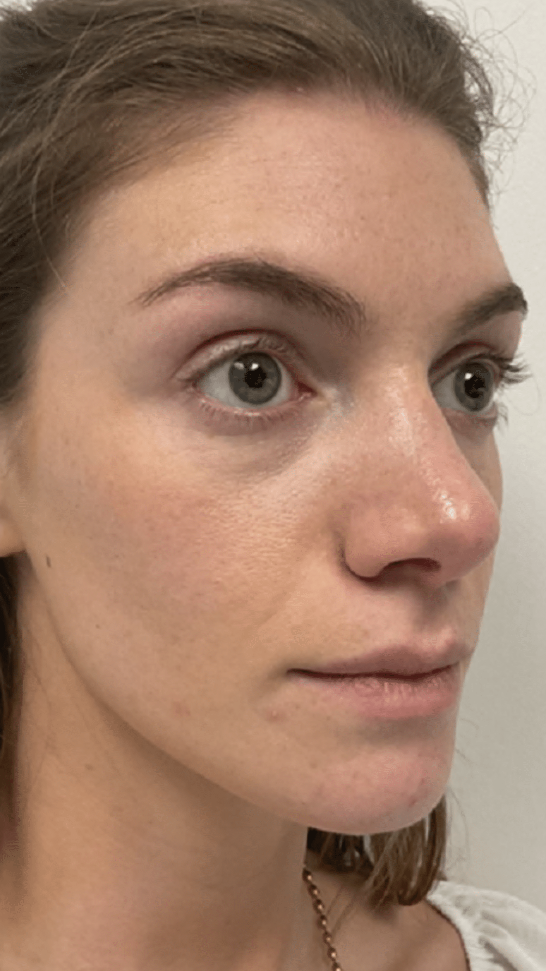 Cheek filler by Chrissy Handly at Cool Springs Plastic Surgery in Brentwood and Franklin, TN case 49