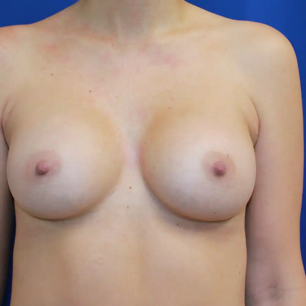 After breast augmentation with smooth, round, full 295cc implants placed under the muscle – Dr. Konrad Sarosiek, MD