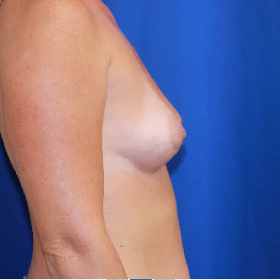 Breast augmentation before and after – Smooth Round Full 415cc implants – Dr. Sarosiek – Case 1045