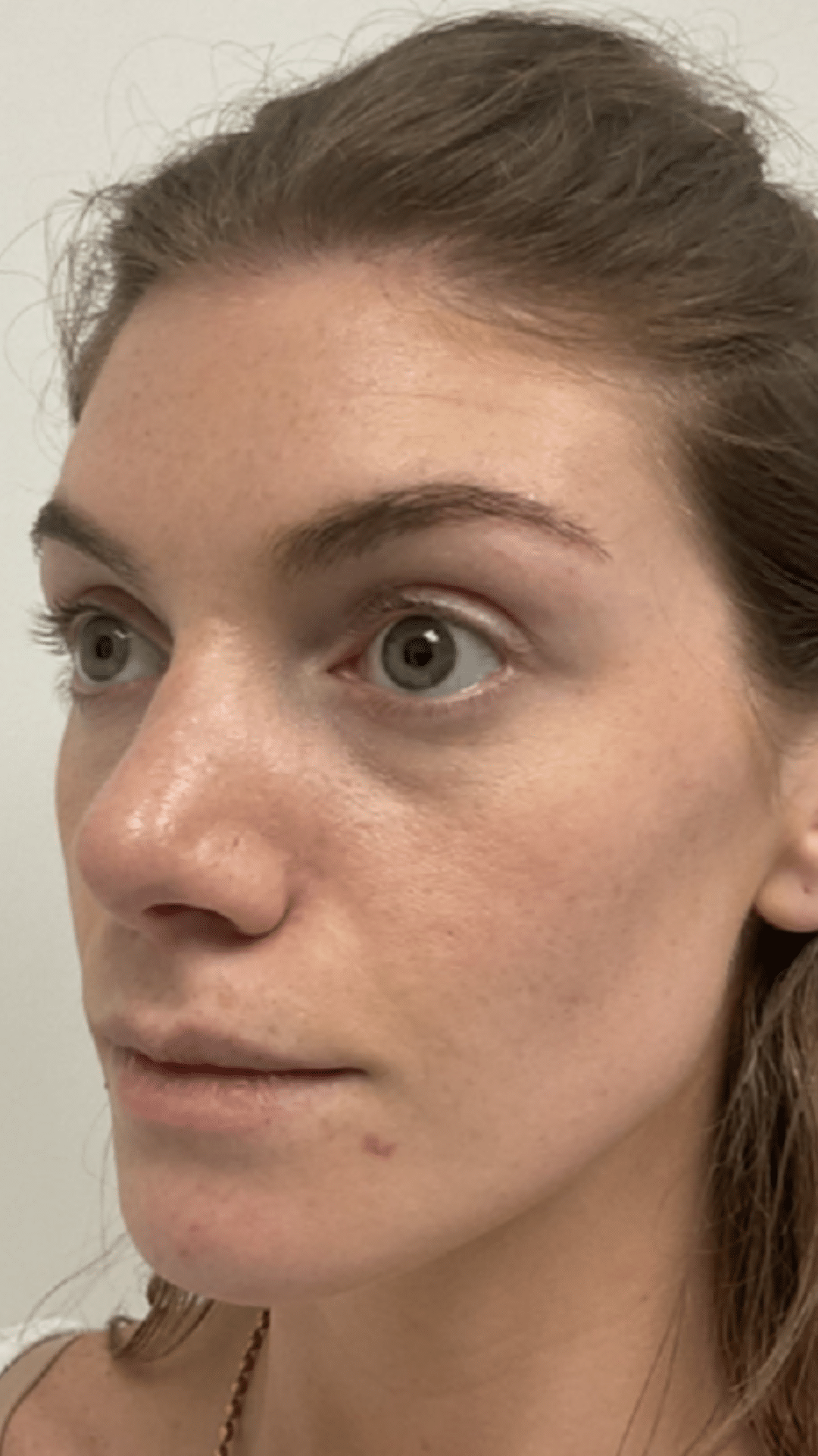 Cheek filler by Chrissy Handly at Cool Springs Plastic Surgery in Brentwood and Franklin, TN showing natural midface rejuvenation and balanced results.