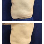 coolsculpting results at cool springs plastic surgery