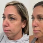 Facial balancing filler by Chrissy Handly, RN at Cool Springs Plastic Surgery in Brentwood and Franklin