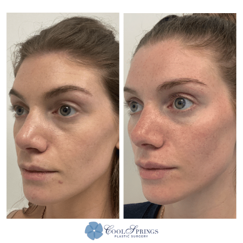 cheek filler before and after in franklin tn