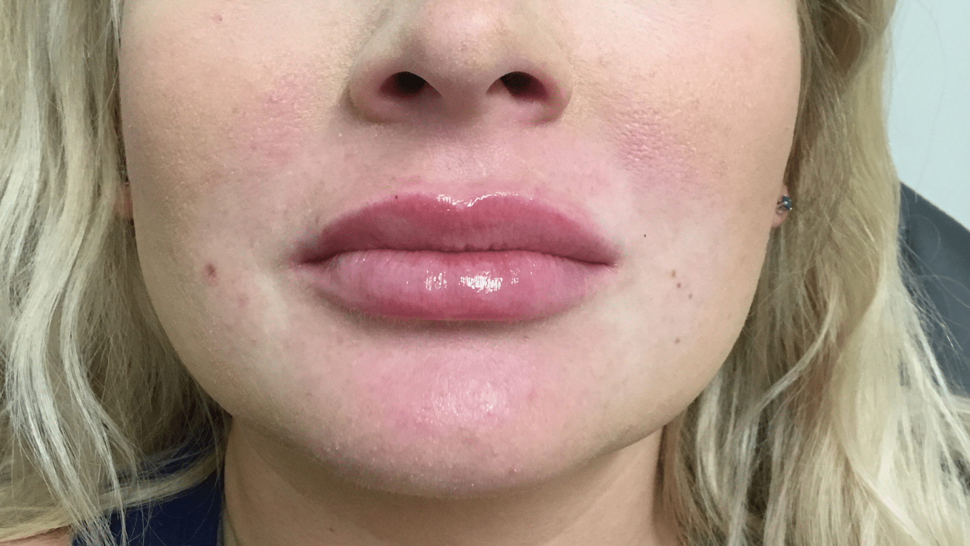 Lip Filler After