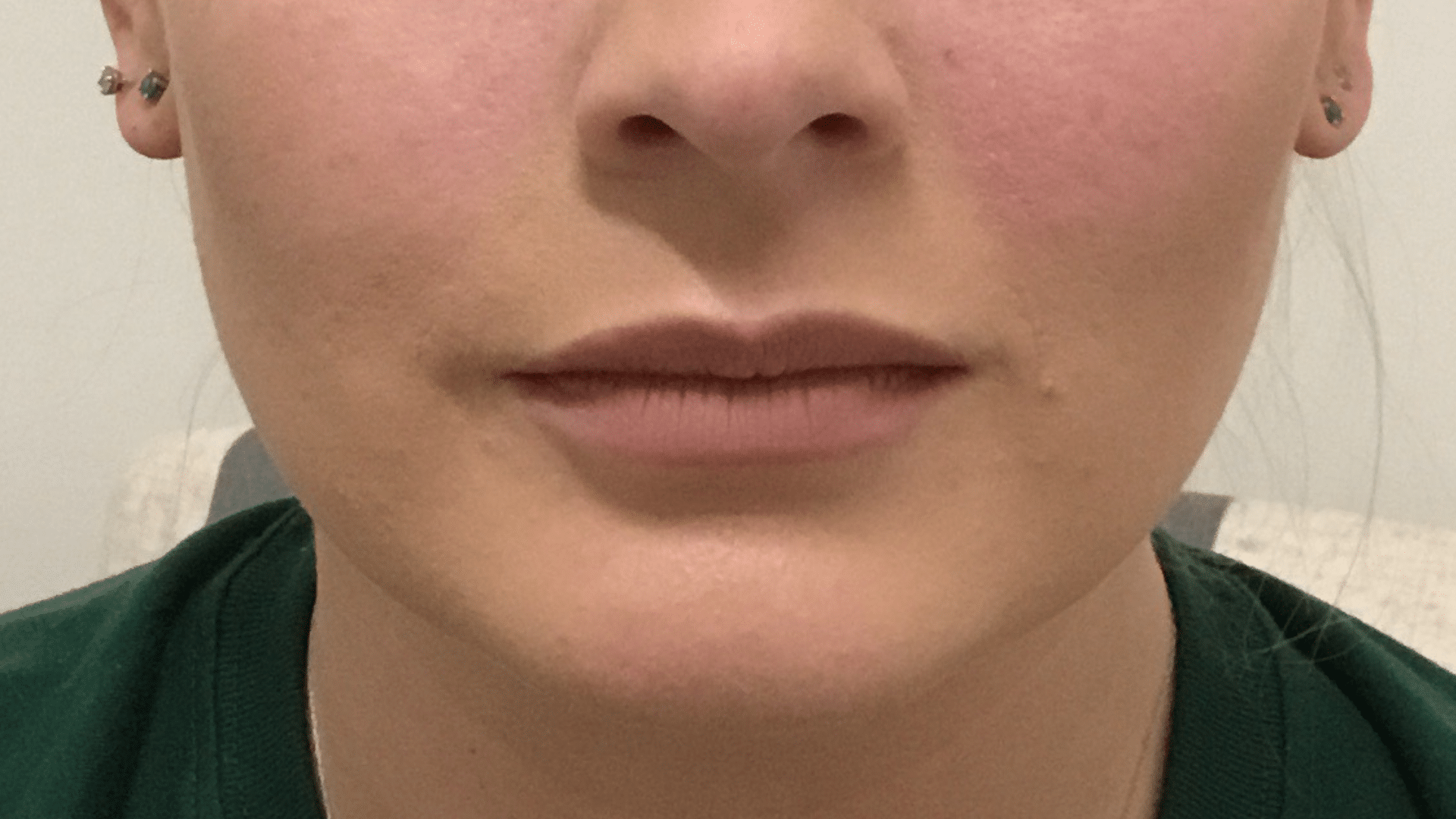 Lip Filler Before