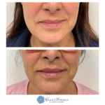 case 55 before and after midface filler by chrissy
