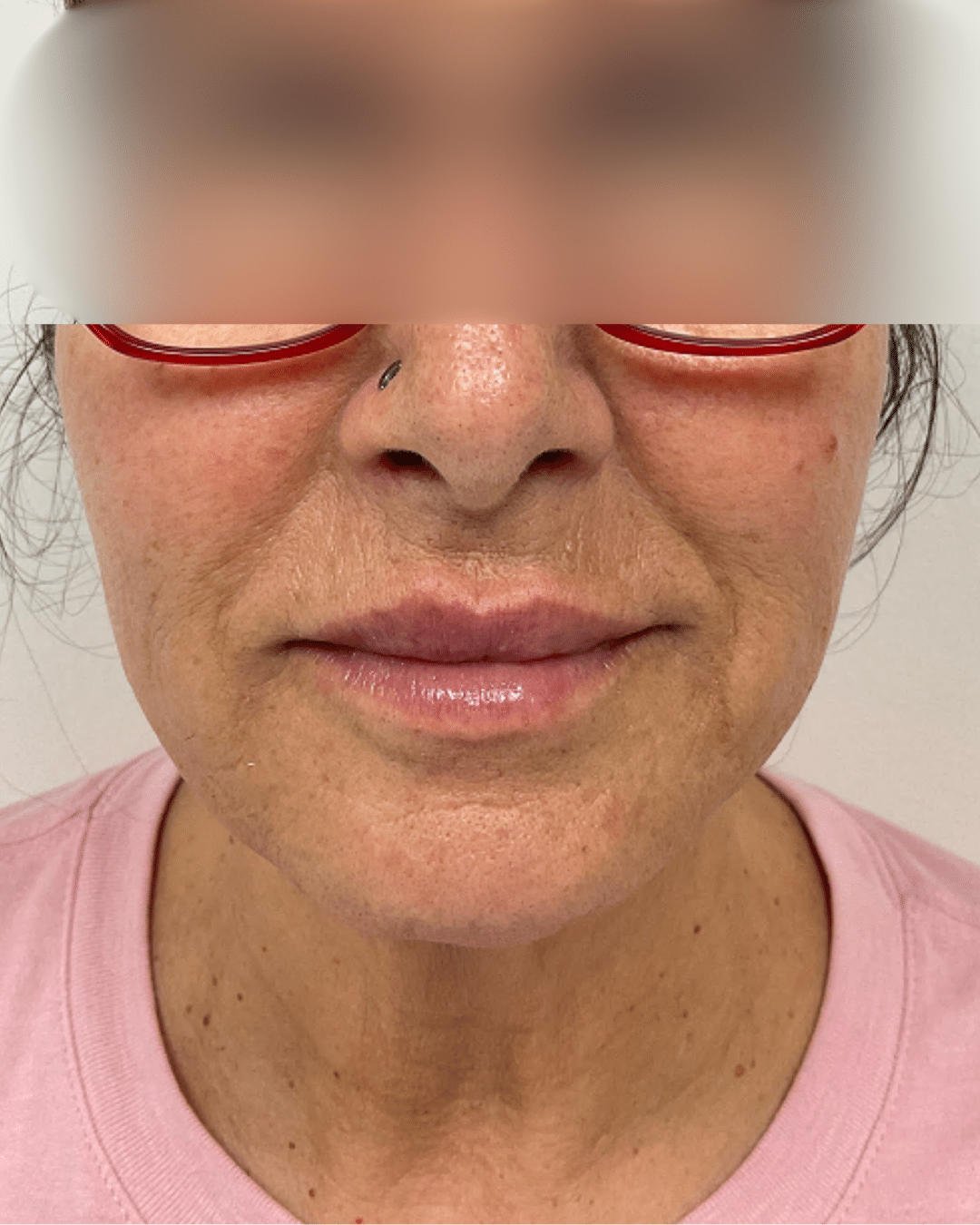 case 55 - mid face filler