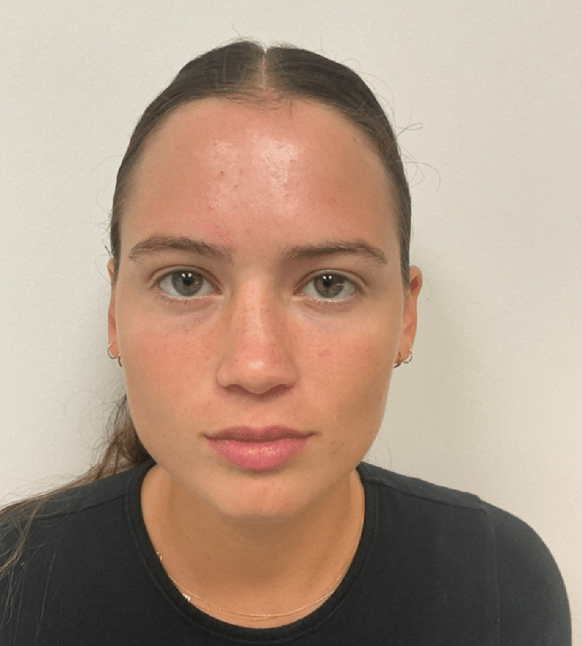 botox after with forehead wrinkles eleven lines