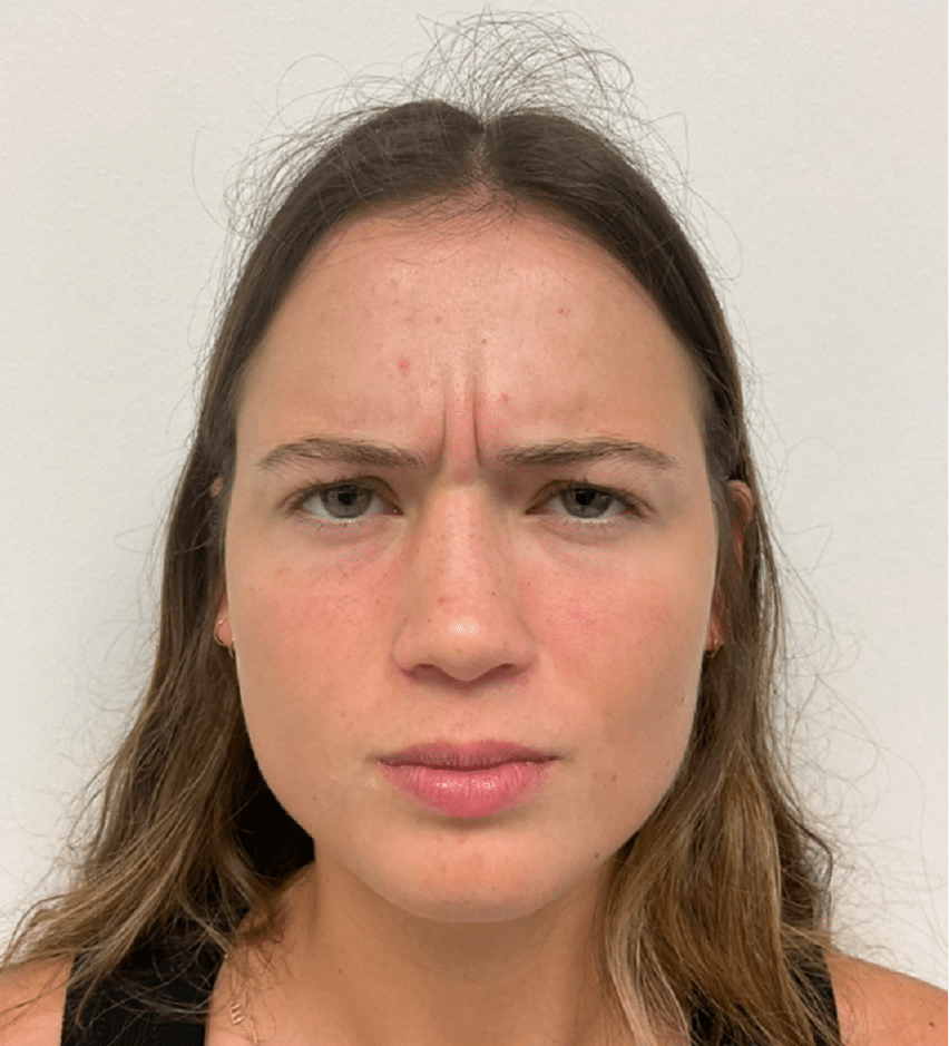 botox before with forehead wrinkles eleven lines