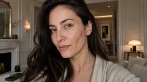skin pen microneedling in franklin to help get rid of acne scars
