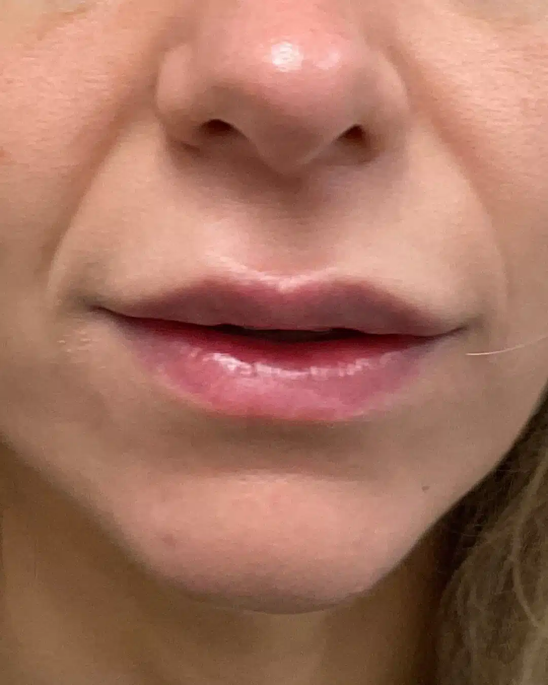 Lip filler after photo from angled facial view at Cool Springs Plastic Surgery near Nashville