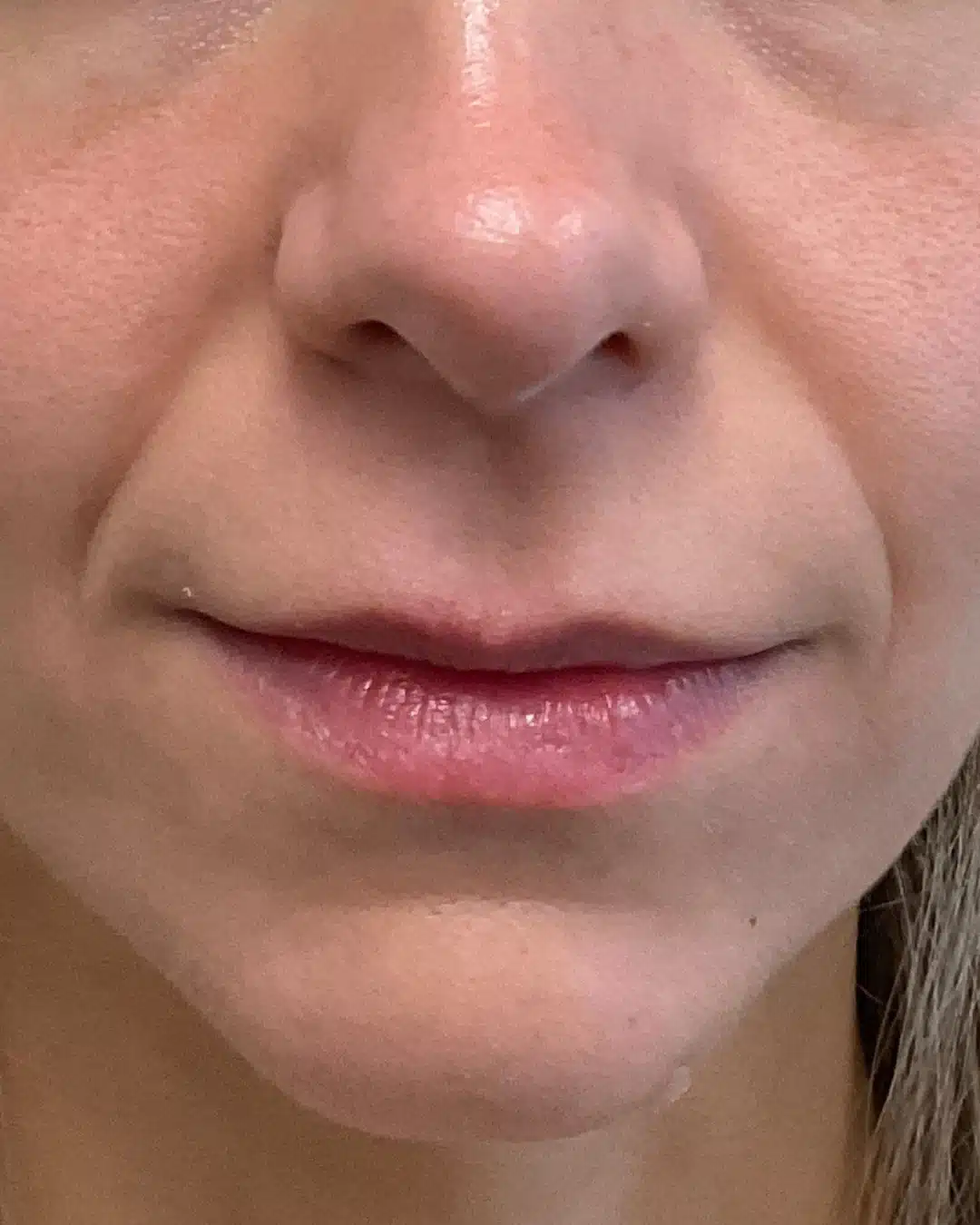Lip filler before photo from angled facial view at Cool Springs Plastic Surgery near Nashville