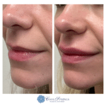 lip filler in franklin by crhissy at csps