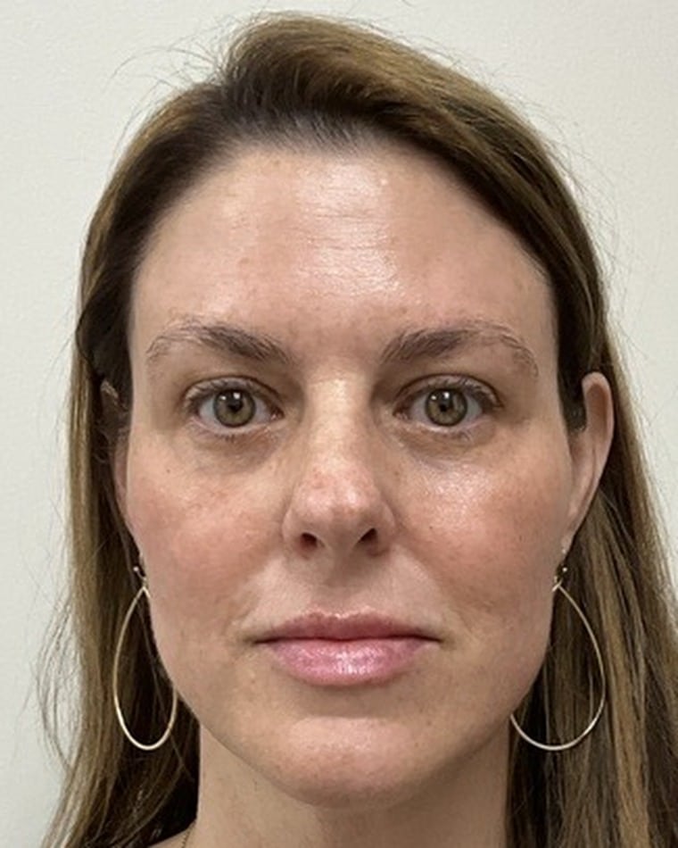 After Halo + BBL laser, under-eye PDGF, and lip and cheek filler with Kaitlyn Jones, PA-C at Cool Springs Plastic Surgery — front view showing clearer, more even skin