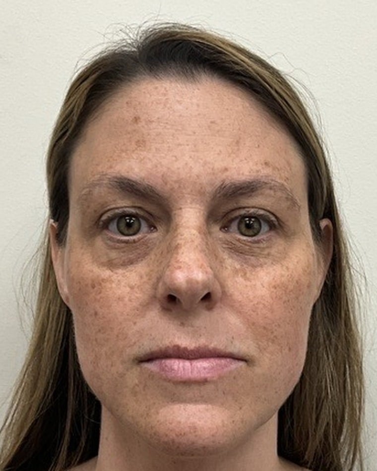Before Halo + BBL laser, under-eye PDGF, and lip and cheek filler with Kaitlyn Jones, PA-C at Cool Springs Plastic Surgery — front view showing facial pigment and sun damage
