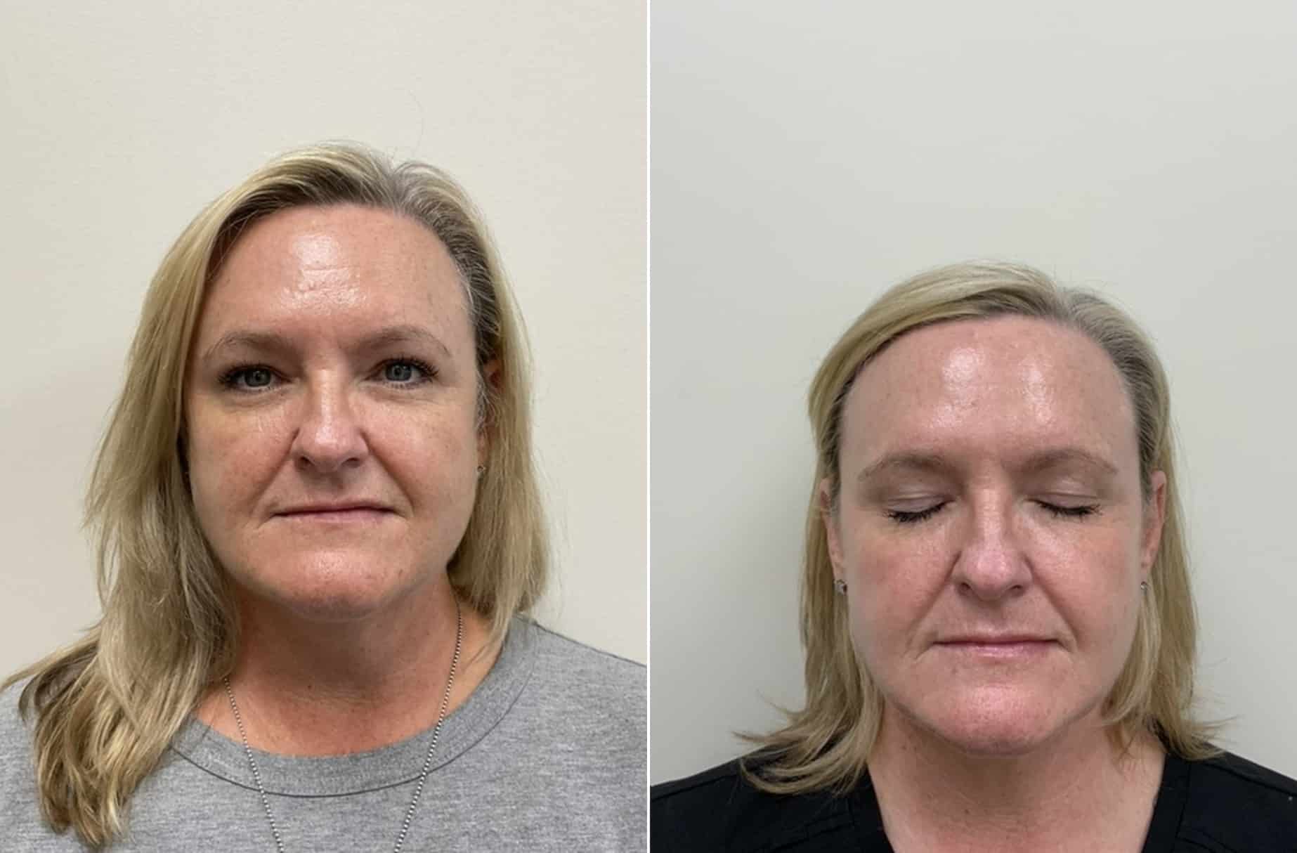 BBL and Moxi laser before and after photos — CSPS patient with Destiny Berger, LE — Brentwood TN