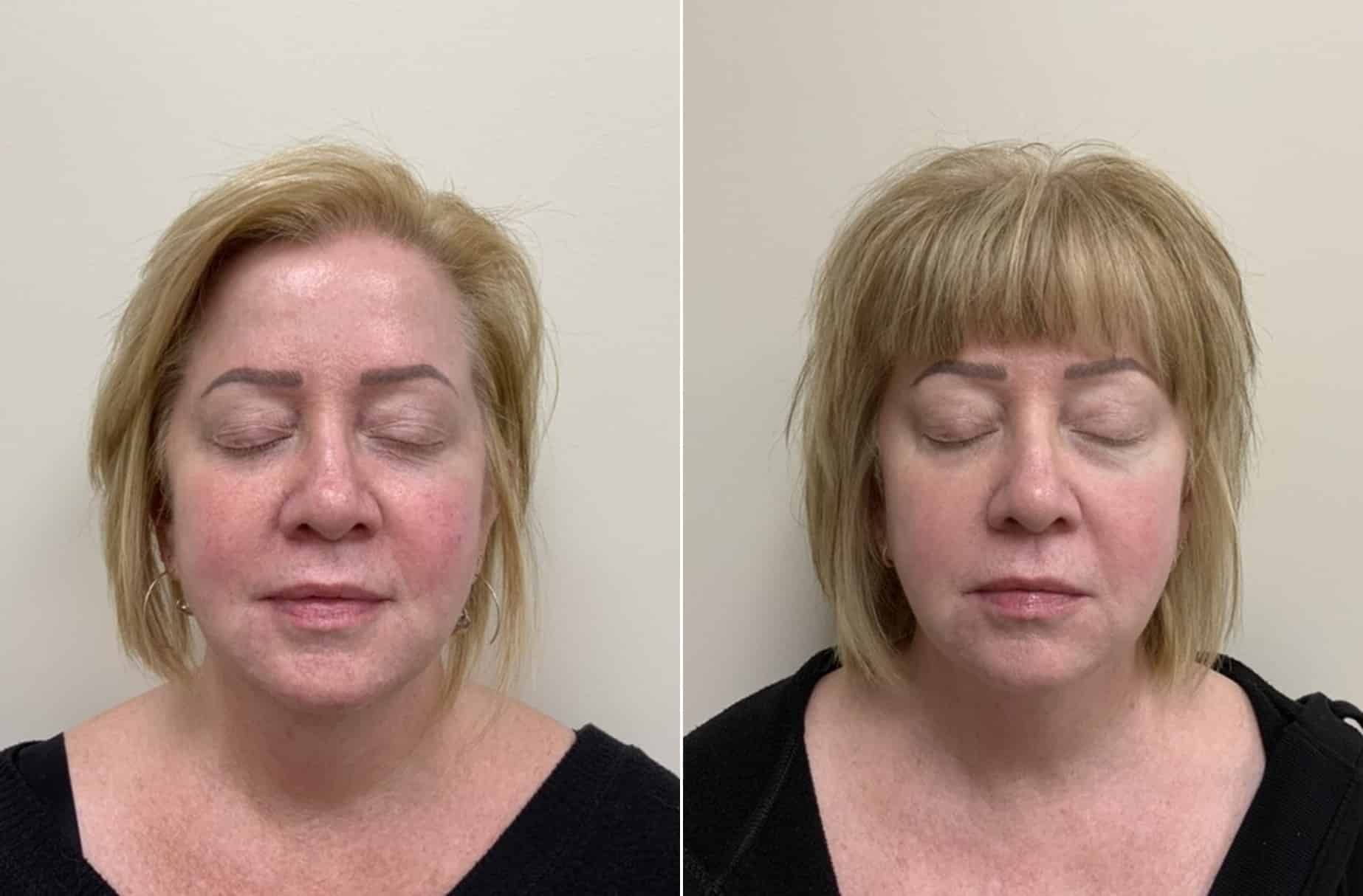 BBL and Moxi laser before and after photos — CSPS patient with Destiny Berger, LE — Brentwood TN