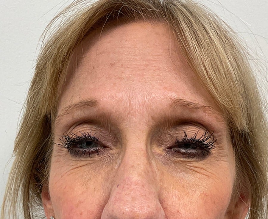 Botox after photo, smoother glabella — Chrissy Handly, Case 65, Cool Springs Plastic Surgery, Brentwood TN