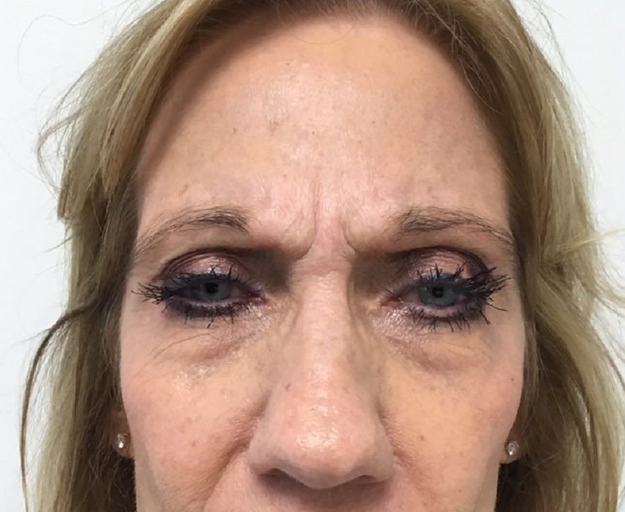 Botox before photo, glabella frown lines — Chrissy Handly, Case 65, Cool Springs Plastic Surgery, Brentwood TN