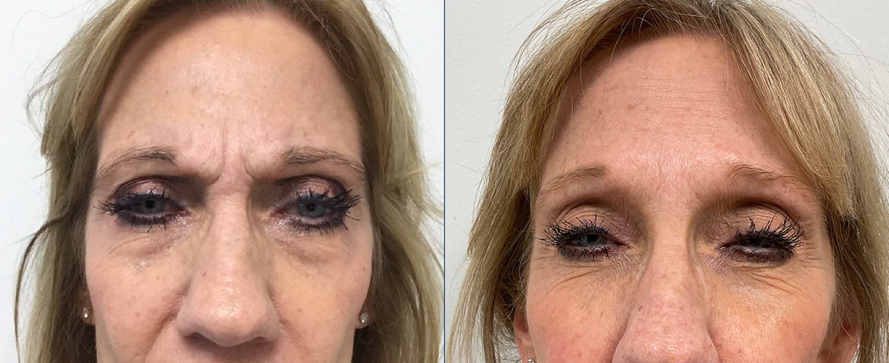 Botox before and after, frown lines — Chrissy Handly, Case 65, Cool Springs Plastic Surgery