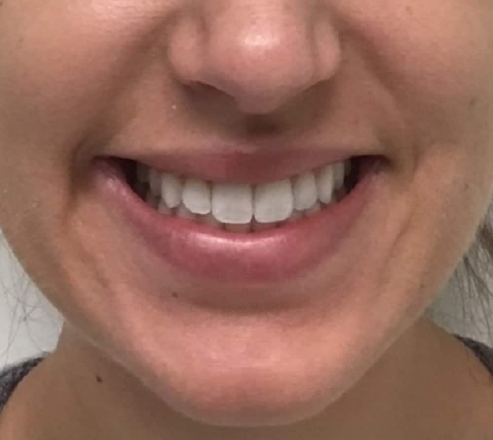 Botox gummy smile after photo — Chrissy Handly, Case 69, Cool Springs Plastic Surgery, Brentwood TN