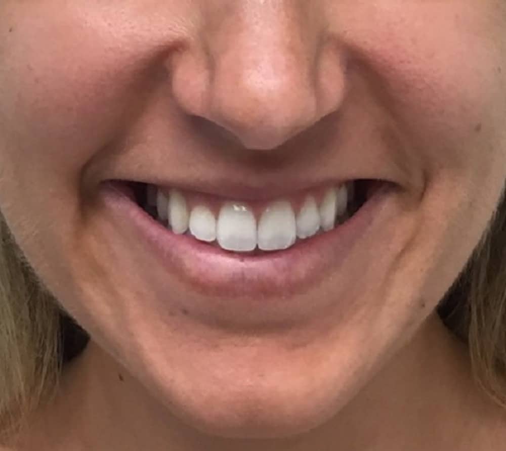 Botox gummy smile before photo — Chrissy Handly, Case 69, Cool Springs Plastic Surgery, Brentwood TN