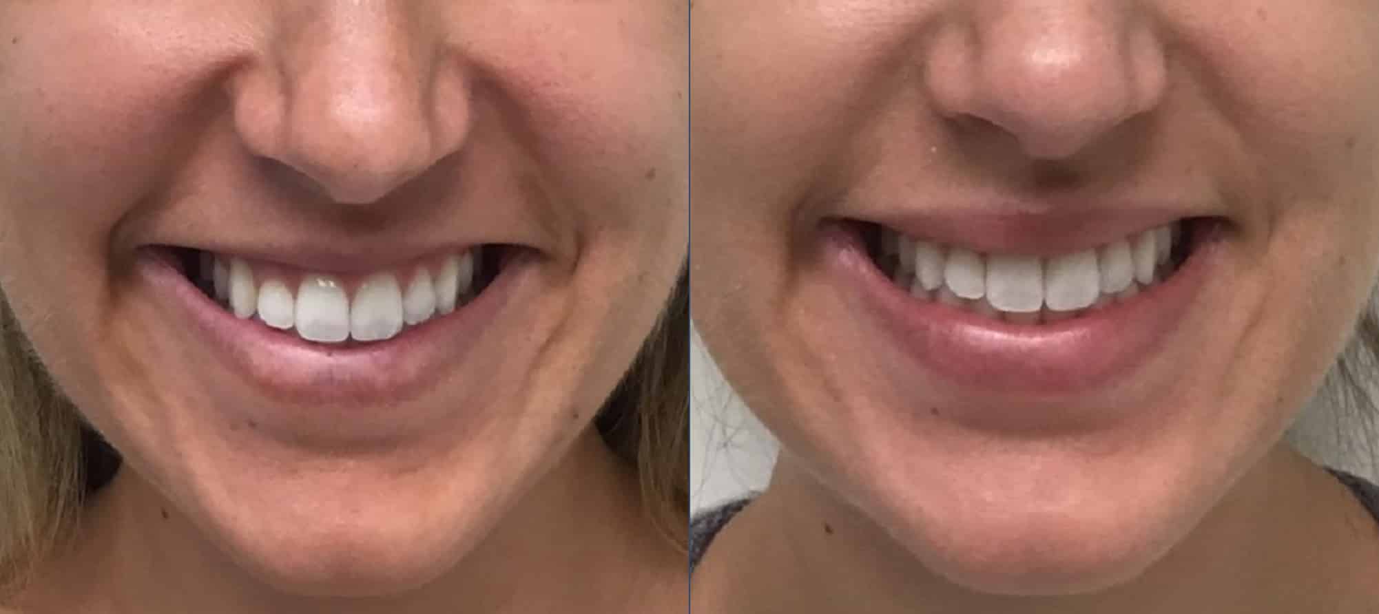 Botox gummy smile before and after — Chrissy Handly, Case 69, Cool Springs Plastic Surgery