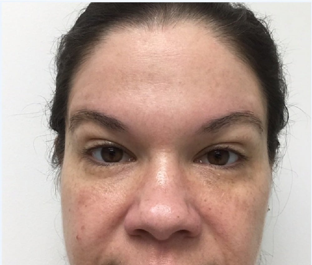 Botox forehead after photo, smooth forehead — Chrissy Handly, Case 70, Cool Springs Plastic Surgery, Brentwood TN