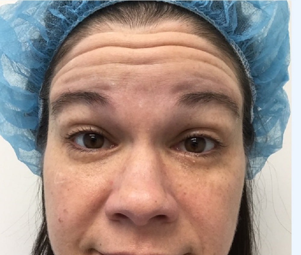 Botox forehead before photo, forehead lines — Chrissy Handly, Case 70, Cool Springs Plastic Surgery, Brentwood TN