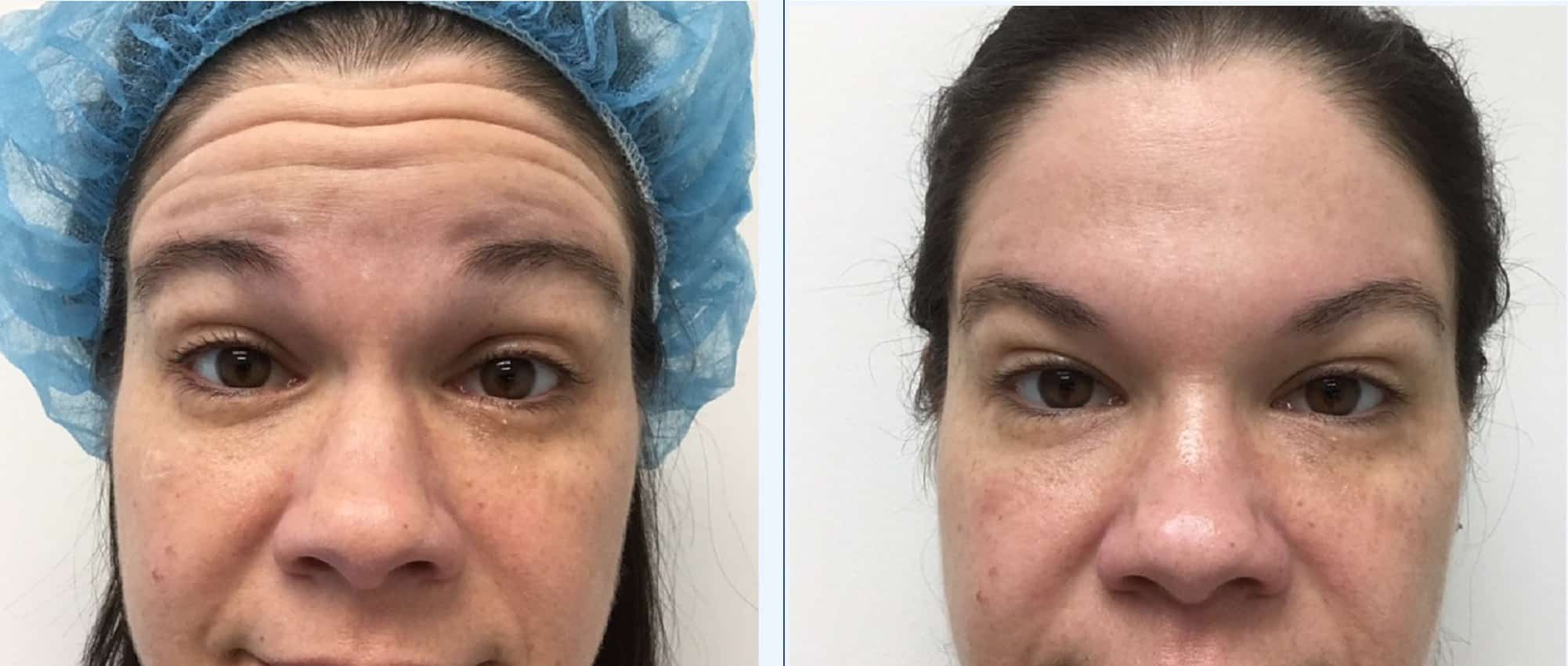 Botox forehead before and after — Chrissy Handly, Case 70, Cool Springs Plastic Surgery